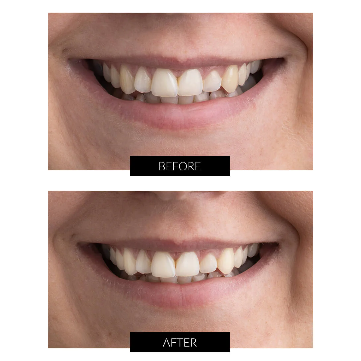 CurrentBody Skin Teeth Whitening Extended Kit - Image 3